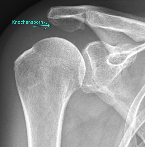 Schema Engpasssyndrom Schulter