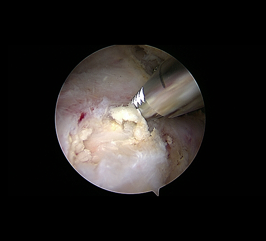 Röntgenbild einer Kalkschulter