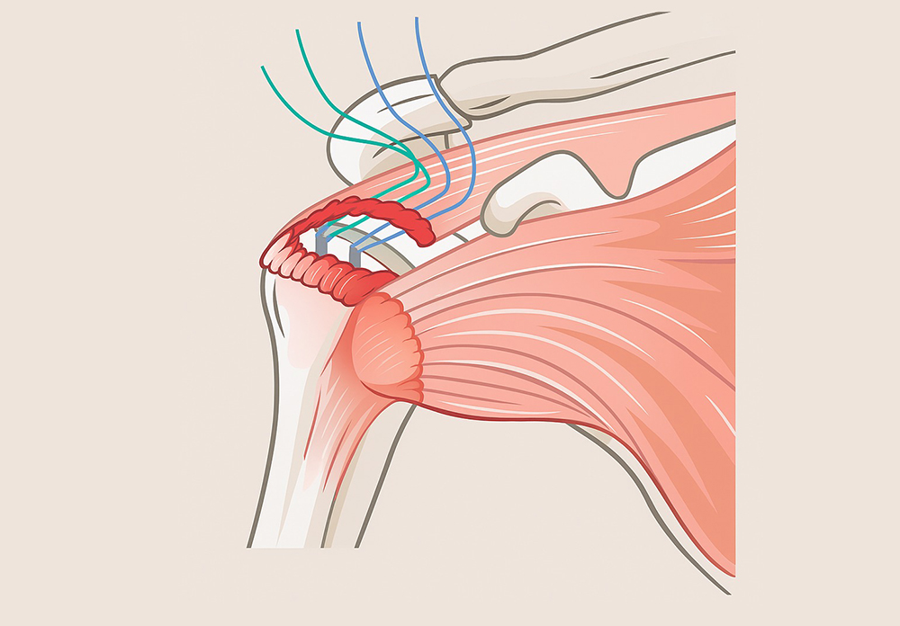 Ankerfäden zur Rekonstruktion