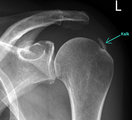 Röntgenbild einer Kalkschulter