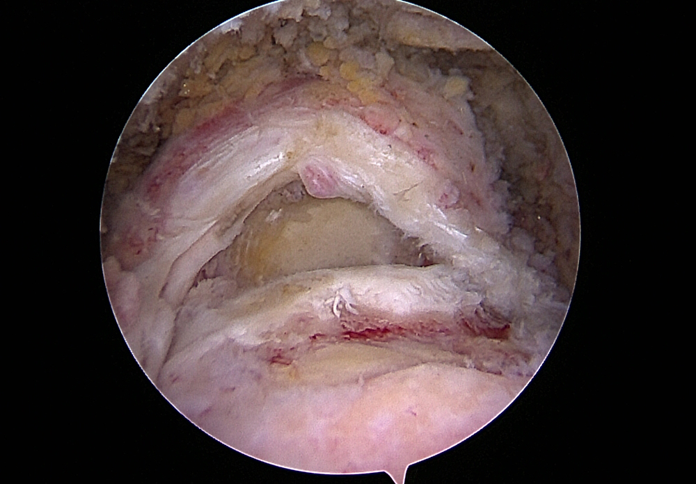 Grosser Riss Rotatorenmanschette