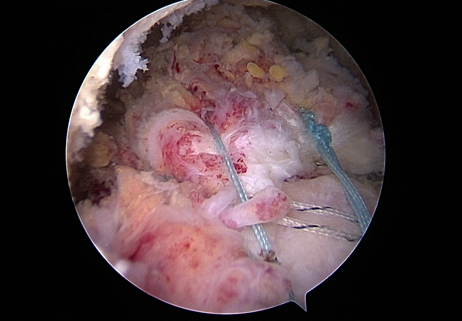 Rekonstruierte Rotatorenmanschette